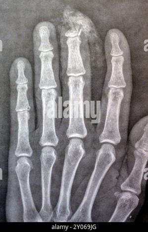 I raggi X semplici rivelano l'amputazione distale della falange distale del dito medio della mano sinistra di un uomo adulto, causata da una macchina a lama affilata e Foto Stock