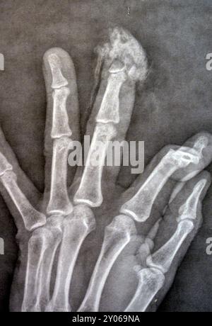 I raggi X semplici rivelano l'amputazione distale della falange distale del dito medio della mano sinistra di un uomo adulto, causata da una macchina a lama affilata e Foto Stock
