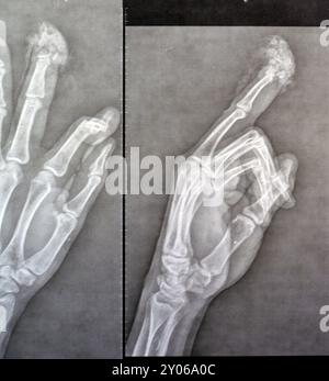 I raggi X semplici rivelano l'amputazione distale della falange distale del dito medio della mano sinistra di un uomo adulto, causata da una macchina a lama affilata e Foto Stock