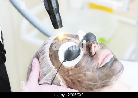 Procedura di peeling della superficie in carbonio per primi piani. Gli impulsi laser puliscono la pelle del viso. Trattamento cosmetologico hardware. Processo di fototermolisi, riscaldamento del Foto Stock