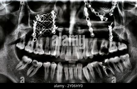 I raggi X panoramici mostrano più piastre, viti per il fissaggio maxillare di una mascella fratturata, rete in titanio sul lato destro, UL6 decaduto, radice con guasto LL6 Foto Stock
