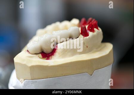 Modello a ganascia superiore con corone in ceramica attaccate Foto Stock