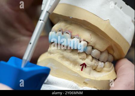 Corone in ceramica colorate nel modello della ganascia superiore Foto Stock