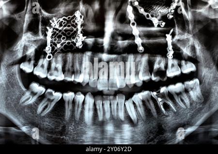 I raggi X panoramici mostrano più piastre, viti per il fissaggio maxillare di una mascella fratturata, rete in titanio sul lato destro, UL6 decaduto, radice con guasto LL6 Foto Stock