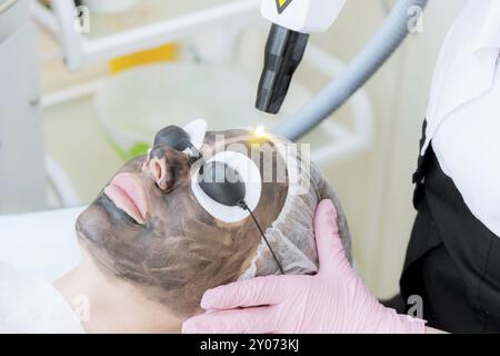 Procedura di peeling della superficie in carbonio per primi piani. Gli impulsi laser puliscono la pelle del viso. Trattamento cosmetologico hardware. Processo di fototermolisi, riscaldamento del Foto Stock