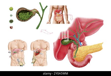 Ilustration medico che mostra calcoli biliari nella colecisti e la rimozione chirurgica della colecisti, nota come colecistectomia Foto Stock