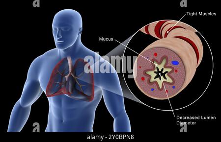 Illustrazione medica di un bronchiolo asmatico nel tratto respiratorio umano Foto Stock