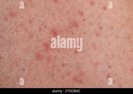 Macchie rosse che coprono la pelle umana, soffrono di malattie croniche della pelle, concetto per la sanità e la medicina Foto Stock