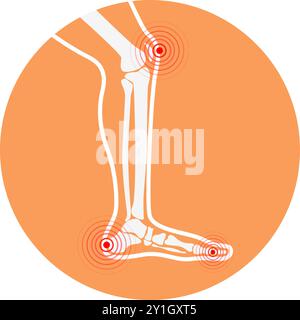 Zone di dolore alle gambe umane. Elementi di progettazione per infografica. Illustrazione Vettoriale