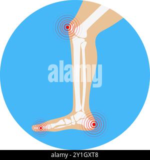 Zone di dolore alle gambe umane. Elementi di progettazione per infografica. Illustrazione Vettoriale