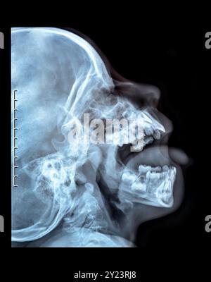 Radiografia di un cranio della persona. Radiografia radiografia mandibola fratturata ossa nasofaringee di alta qualità Foto Stock