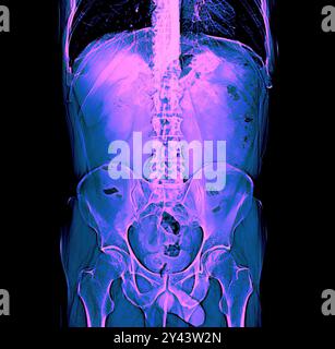 Radiologische Diagnose 20240916ad002 Anatomie, Befund, Bildgebung, Brust, Brustkorb, CT, Diagnose, Durchleuchtung, Gesundheit, Kernspintomographie, eingefärbt, gefärbt, Knochen, Körper, Krebs, Krankenhaus, Lunge, Lungenerkrankung, Lungenflügel, Magnetresonanztomographie, medizinisch, MRT, Oberkörper, Radiologe, Radiologie, Röntgen, Röntgenaufnahme, Röntgenbild, Röntgendiagnostik, Röntgenstrahlen, Rippen, Rippenbogen, scanner, Skelett, Spital, Strahlen, Thorax, Tomographie, Untersuchung, Untersuchungsergebnis, Vorsorge, Weichteile Hamburg Deutschland Germania *** diagnosi radiologica 2 Foto Stock