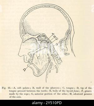 Un uomo impiccato A. palato molle; B, parete della faringe; C, lingua; D, punta della lingua premuta tra i denti; e, corpo dell'osso ioide; F, scanalatura fatta dalla corda; G, parte anteriore dell'atlante; H, processo odontoide dell'asse. From Forensic medicine and Toxicology by Mann, J. Dixon (John Dixon), 1840-1912 data di pubblicazione 1898 pubblicato da Charles Griffin Foto Stock