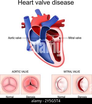 Malattia della valvola cardiaca. Sezione trasversale del cuore umano. Primo piano della valvola mitrale e aortica. Valvola sana e stenosi. Valvulopatia cardiaca. Vettore. SC Illustrazione Vettoriale