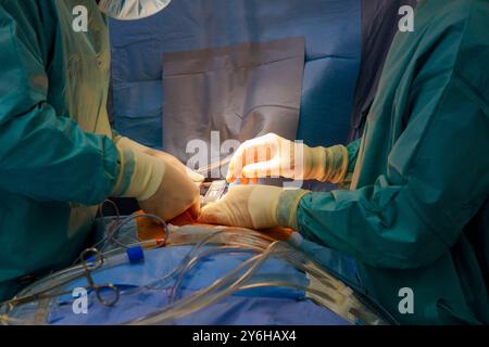 Nella sala operatoria dell'ospedale, l'équipe chirurgica esegue la chirurgia a cuore aperto sul paziente Foto Stock