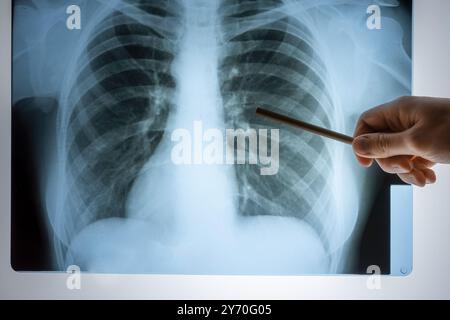 Radiografia dei polmoni. Vista medica dell'immagine polmonare in ospedale su una tavola riflettente, messa a fuoco sfocata Foto Stock