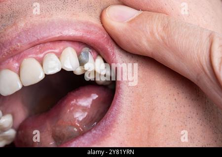 Maschio caucasico bocca aperta e denti con dente premolare superiore rotto dopo il trattamento del canale radicale dentale. Cemento dentario grigio scuro prima del nuovo permanente c Foto Stock