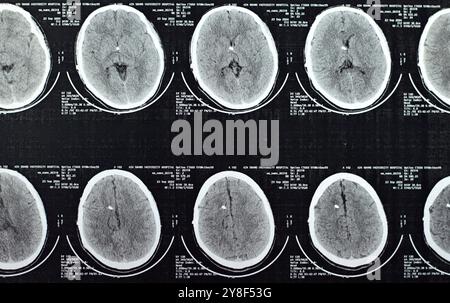 Cairo, Egitto, settembre 26 2024: Un caso di idrocefalo con un tubo di derivazione, la TAC rivela una dilatazione da lieve a moderata dell'intero sistema ventricolare Foto Stock