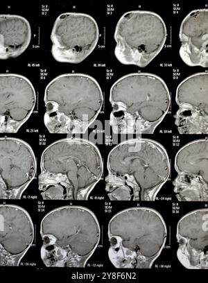 La risonanza magnetica del cervello rivela precedenti operazioni di shunt per un caso di idrocefalo, lesione para-falcina pre-ventricolare anteriore destra che migliora la lesione con il sospetto Foto Stock