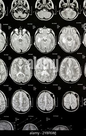 La risonanza magnetica del cervello rivela precedenti operazioni di shunt per un caso di idrocefalo, lesione para-falcina pre-ventricolare anteriore destra che migliora la lesione con il sospetto Foto Stock