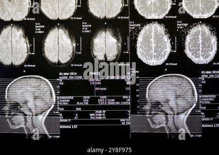 La risonanza magnetica del cervello rivela precedenti operazioni di shunt per un caso di idrocefalo, lesione para-falcina pre-ventricolare anteriore destra che migliora la lesione con il sospetto Foto Stock