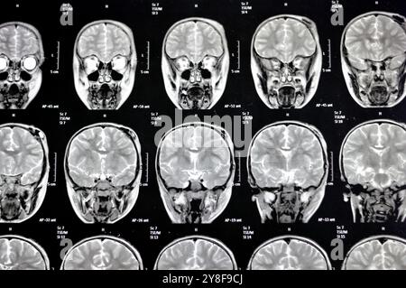 La risonanza magnetica del cervello rivela precedenti operazioni di shunt per un caso di idrocefalo, lesione para-falcina pre-ventricolare anteriore destra che migliora la lesione con il sospetto Foto Stock