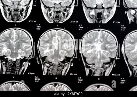 La risonanza magnetica del cervello rivela precedenti operazioni di shunt per un caso di idrocefalo, lesione para-falcina pre-ventricolare anteriore destra che migliora la lesione con il sospetto Foto Stock