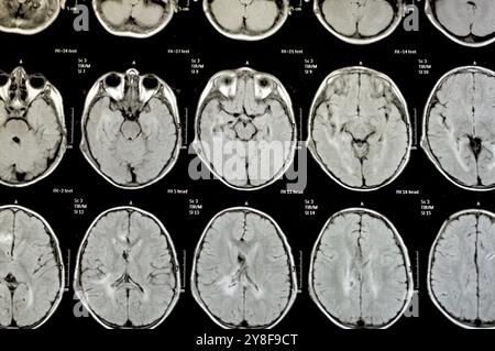 La risonanza magnetica del cervello rivela precedenti operazioni di shunt per un caso di idrocefalo, lesione para-falcina pre-ventricolare anteriore destra che migliora la lesione con il sospetto Foto Stock