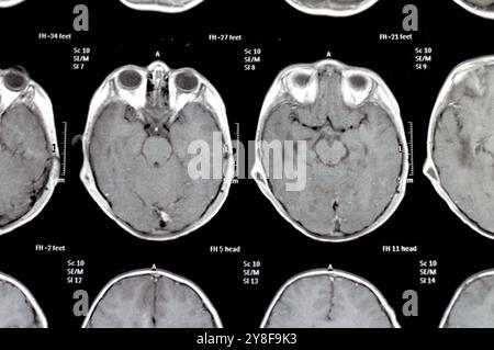 La risonanza magnetica del cervello rivela precedenti operazioni di shunt per un caso di idrocefalo, lesione para-falcina pre-ventricolare anteriore destra che migliora la lesione con il sospetto Foto Stock