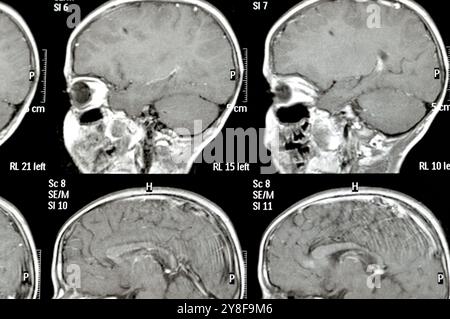 La risonanza magnetica del cervello rivela precedenti operazioni di shunt per un caso di idrocefalo, lesione para-falcina pre-ventricolare anteriore destra che migliora la lesione con il sospetto Foto Stock