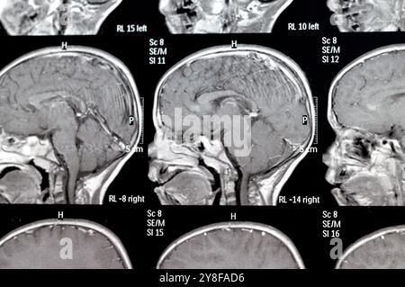 La risonanza magnetica del cervello rivela precedenti operazioni di shunt per un caso di idrocefalo, lesione para-falcina pre-ventricolare anteriore destra che migliora la lesione con il sospetto Foto Stock