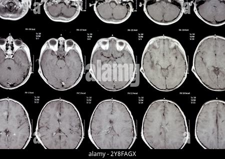 La risonanza magnetica del cervello rivela precedenti operazioni di shunt per un caso di idrocefalo, lesione para-falcina pre-ventricolare anteriore destra che migliora la lesione con il sospetto Foto Stock