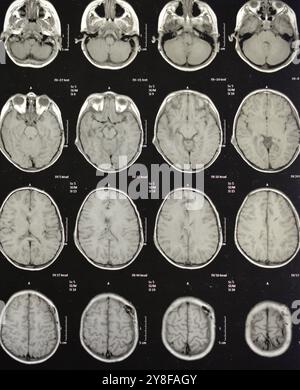 La risonanza magnetica del cervello rivela precedenti operazioni di shunt per un caso di idrocefalo, lesione para-falcina pre-ventricolare anteriore destra che migliora la lesione con il sospetto Foto Stock