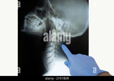 Imaging radiografico del collo. Dischi vertebrali RM in viste diverse Foto Stock