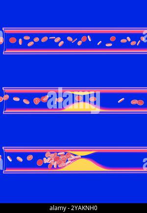 Illustrazione 3D dell'interno di un'arteria di vetro trasparente. Ostruito dall'accumulo di grasso (colesterolo). Movimento dei globuli rossi. Foto Stock