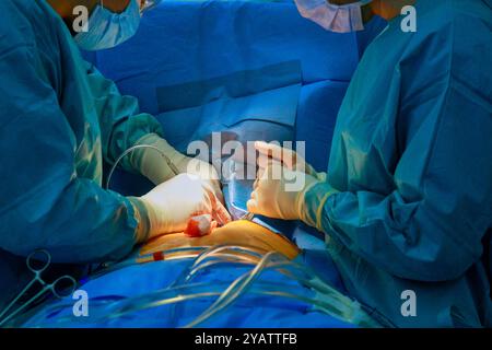 Durante la chirurgia a cuore aperto in ospedale, il team medico di chirurghi esegue la chirurgia sul paziente Foto Stock