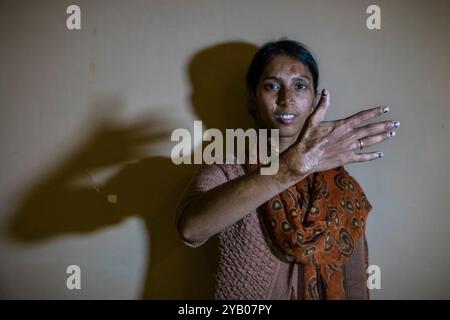 India, Calcutta, donne vittime attacco acido, ritratto Foto Stock