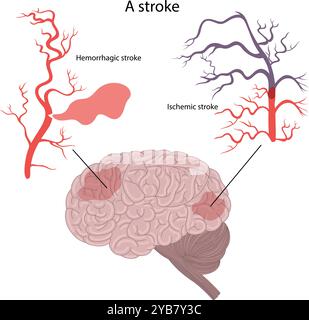 . Ictus emorragico e ictus ischemico del cervello. Illustrazione Vettoriale