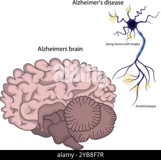 Cervello con malattia di Alzheimer. Illustrazione Vettoriale