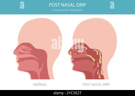 Gocciolamento post-nasale. Malattie nasali. Progettazione infografica medica. Illustrazione vettoriale Illustrazione Vettoriale