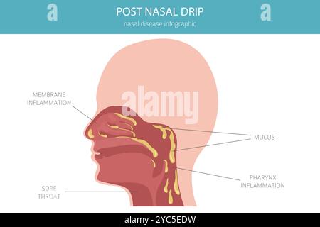 Gocciolamento post-nasale. Malattie nasali. Progettazione infografica medica. Illustrazione vettoriale Illustrazione Vettoriale