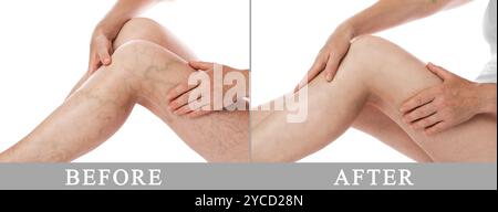Trattamento delle vene varicose. Donna che mostra le gambe su sfondo bianco, primo piano. Prima e dopo il collage Foto Stock