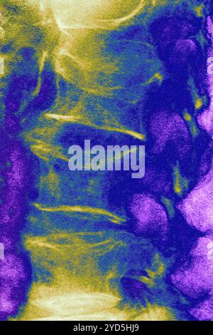 Osteoporosi lombare (malattia che causa compressione e fratture delle vertebre lombari). Radiografia delle vertebre lombari vista dalla parte anteriore. Foto Stock