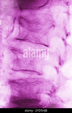Osteoporosi lombare (malattia che causa compressione e fratture delle vertebre lombari). Radiografia delle vertebre lombari vista dalla parte anteriore. Foto Stock