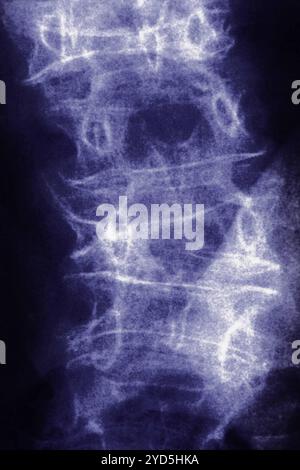 Osteoporosi lombare (malattia che causa compressione e fratture delle vertebre lombari). Radiografia delle vertebre lombari vista dalla parte anteriore. Foto Stock