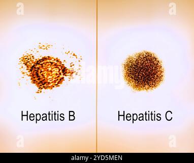 Immagini a micrografia elettronica a trasmissione affiancata di virioni dell'epatite B e C. Foto Stock