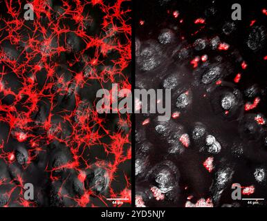 Immagini affiancate che mostrano depositi di fibrina (simili a stringhe. Foto Stock