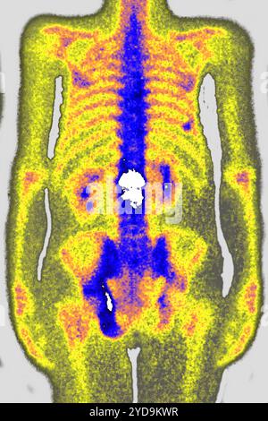 Malattia da osteoporosi lombare che causa compressione e fratture delle vertebre lombari. Radiografia delle vertebre lombari vista dalla parte anteriore. Osteoporosi lombare. 016836 039 Foto Stock