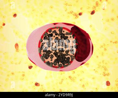 Illustrazione che raffigura una forma ovale rosa e rossa delle cellule infette da clamidia. I batteri Chlamydia trachomatis rappresentati da piccole forme sferiche il marrone colorato subiscono lo sviluppo all'interno di una zona centrale del corpo di inclusione racchiusa in membrana arancione. L'area rossa scura a destra dell'illustrazione indica il nucleo della cellula. Sullo sfondo c'è un micrografo CDC di cellule gialle che mostrano clamidia corpi di inclusione rossi. . Clamidia 016867 151 Foto Stock