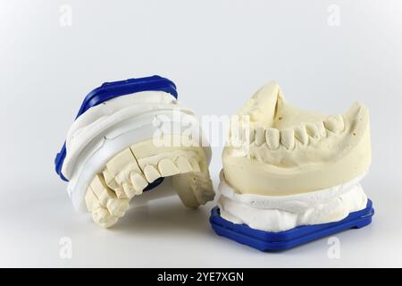Due gesso dentario con bordo blu su sfondo bianco, che rappresentano la fila superiore e inferiore dei denti, impronta per la fabbricazione di un Foto Stock